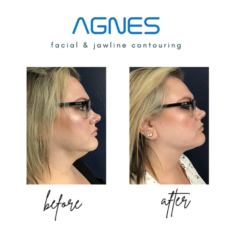 facial and jawline contouring