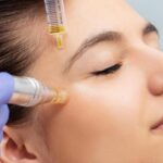 Transform Your Skin with Microneedling Treatments: Infini and Vivace